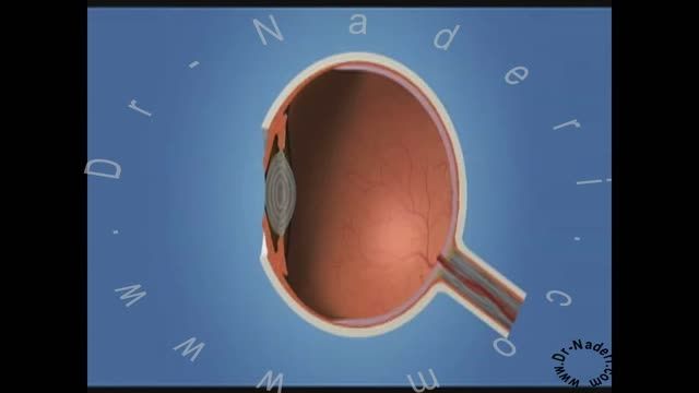 لیزر درمانی در دیابت- مرکز چشم پزشکی دکتر علیرضا نادری