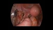 surgiwrap in  myomectomy