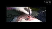عمل جراحی بینی دماغ دختر+دانلود فیلم کلیپ گلچین صفاسا