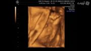 سونوگرافی سه بعدی جنین. مالیدن چشمها و خمیازه جنین