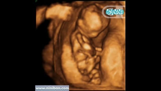 سونوگرافی چهار بعدی در بارداری هفته دوازدهم