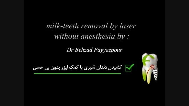 کشیدن دندان شیری با دستگاه لیزر اربیوم