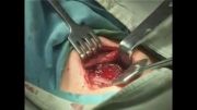 perclot(responder) in thyroid surgery