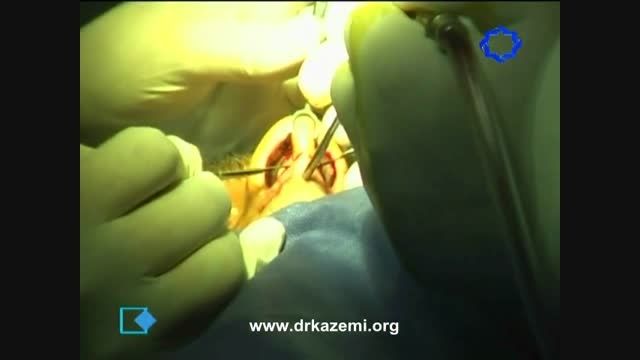 فیلم جراحی بینی به روش باز توسط دکتر کاظمی در شبکه چهار