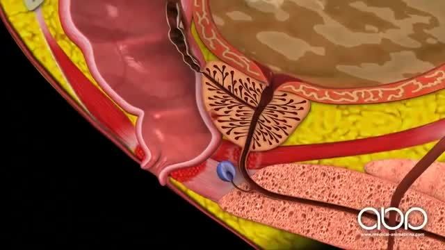 انیمیشن معاینه سرطان پروستات