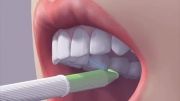 how to use an interdental brush