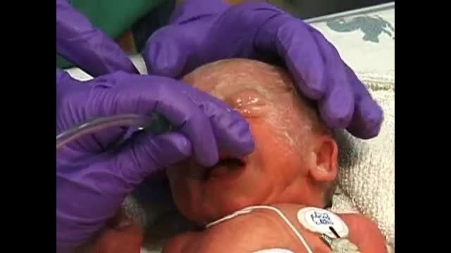 جریان آزاد اکسیژن در نوزادان