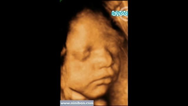 سونوگرافی چهار بعدی در بارداری هفته سی و دوم