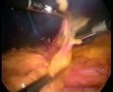 Laparoscopic Splenectomy