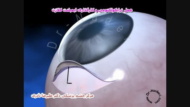 جراحی کارگذاری ایمپلنت گلوکوم-مرکز چشم پزشکی دکترنادری