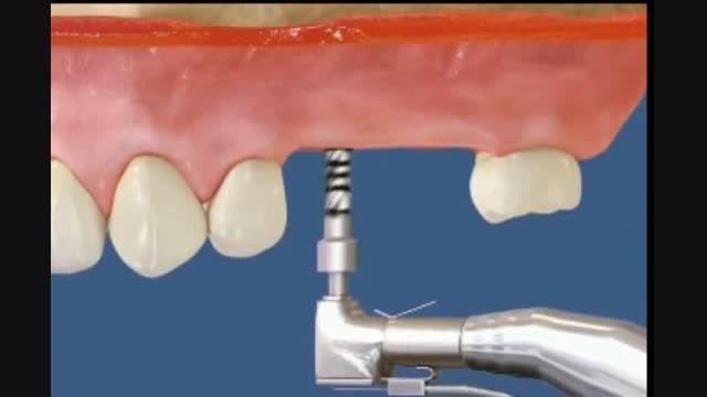 ایمپلنت دندان های عقب مرکز دندانپزشکی وزیبایی دکتر زهدی