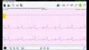 نرم افزار تحلیل سیگنال هولتر ECG نسخه 3 -آنالیز