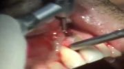 جراحی اپیكو دندان