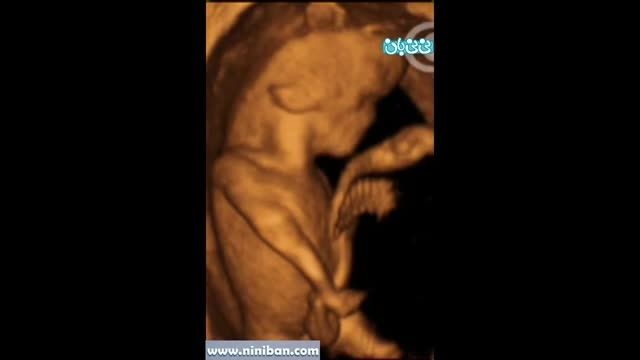 سونوگرافی چهار بعدی در بارداری هفته یازدهم(1)