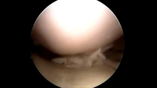 درمان پارگی مینیسک زانو با آرتروسکوپی
