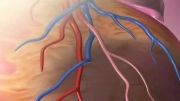 Angioplasty (2)