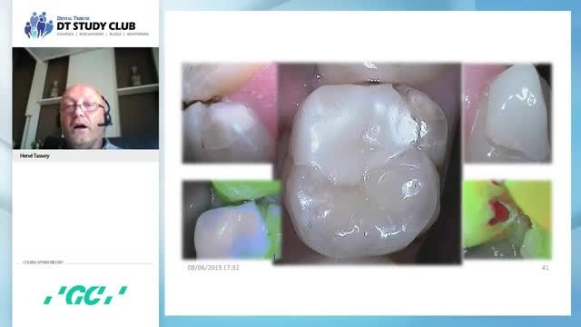 ترمیم کامپوزیتی با حداقل آسیب به بافت دندانی - بخش 2