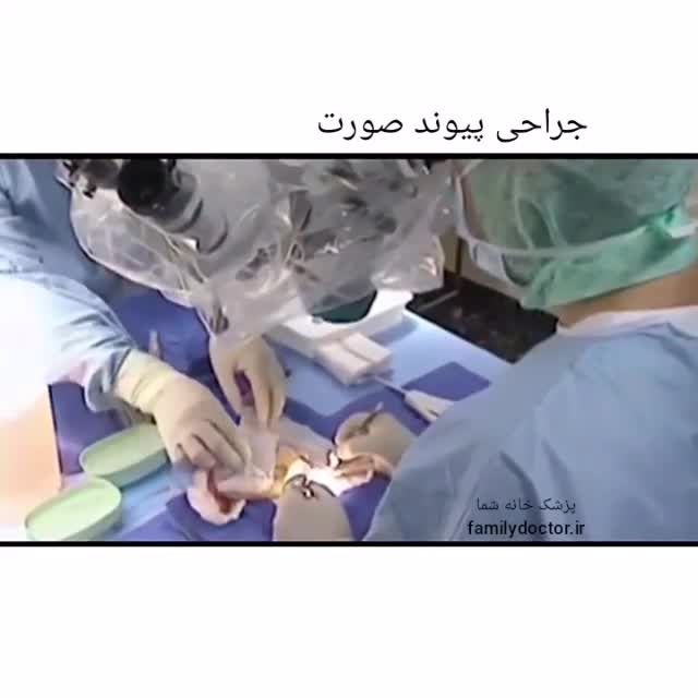 عمل جراحی پیوند صورت