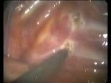 قطع کردن عصب سمپاتیک در جراحی سمپاتکتومی به روش آندوسکوپیک