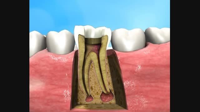 عصب کشی و درمان ریشه دندان بدون درد