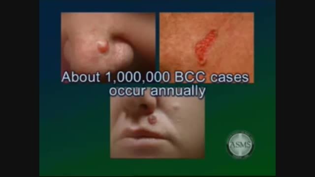 Skin cancer types treatment- melanoma basal cell carcin