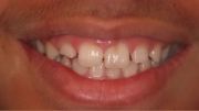 ترمیم دندان شکسته توسط روش باندینگ کامپوزیت