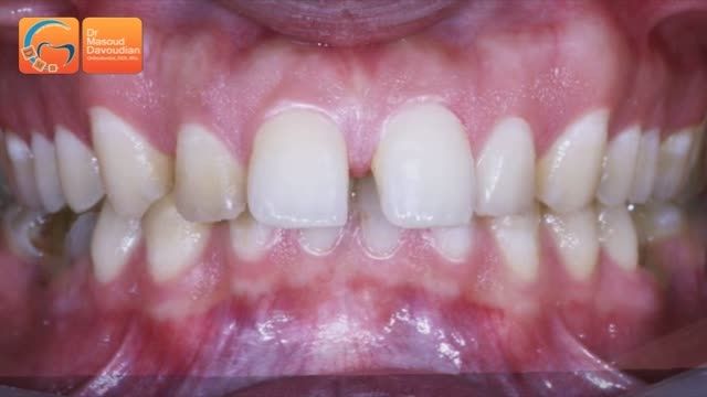 قبل و بعد ارتودنسی بیرون زدگی دندان |دکتر مسعود داودیان