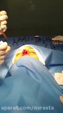 فیلم جراحی بینی  (4)