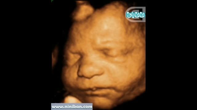 سونوگرافی چهار بعدی در بارداری هفته سی و چهارم