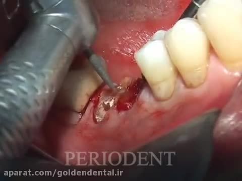 کاشت ایمپلنت دندانی