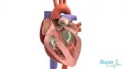 Heart valve replacement surgery