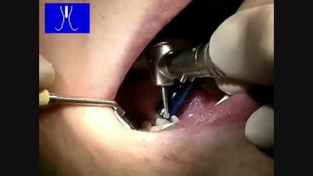 عصب کشی دندان با دستگاه endopilot