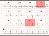 6‪  Predicted Normal ECG - Refinements Section 1_ Part 6