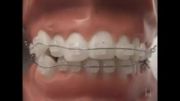 استفاده از نخ دندان در دوران ارتودنسی