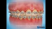 تغییر رنگ دندانها به دنبال عدم رعایت بهداشت در ارتودنسی