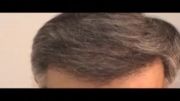 روش ترکیبی در کلینیک کاشت موی دکتر رضائی - قسمت سوم