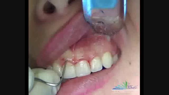 مرکز توسعه علوم دندانپزشکی-جراحی افزایش طول تاج دندان