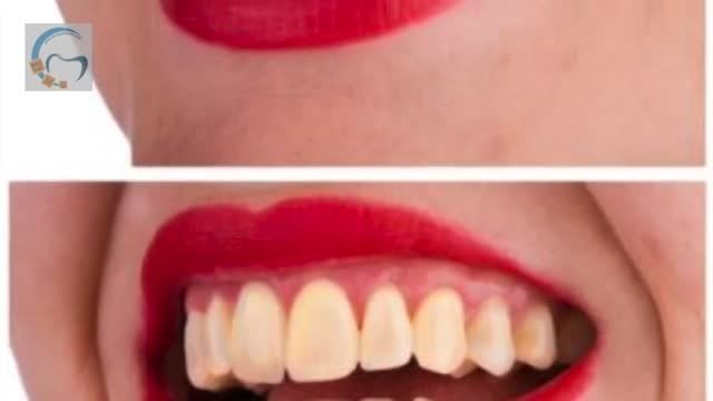 سفید کردن دندانها بعد از ارتودنسی | دکتر مسعود داوودیان