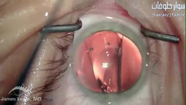 عمل جراحیِ حساسِ قرار دادنِ لنز، در داخل چشم