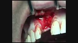 leader Italia  dental Implants  Tixos