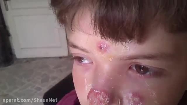 شیوع بیماری های پوستی قارچ های گوشتخار در سوریه