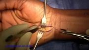 جراحی سندرم تونل کارپال . رها سازی تونل کارپال دست
