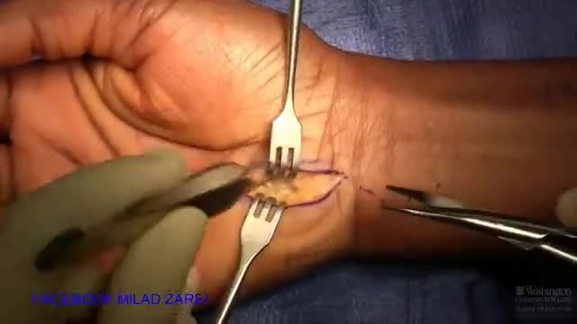 فیلم جراحی عصب دست