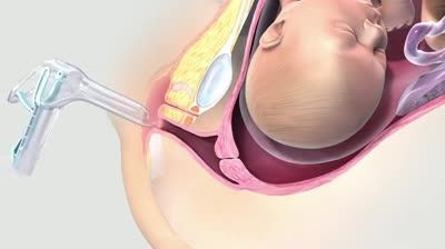 (Cervical Ripening Balloon (CRB