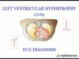 13 Left Ventricular Hypertrophy 1