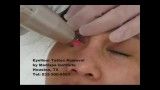 Laser Tattoo Removal - Eyeliner Tattoo