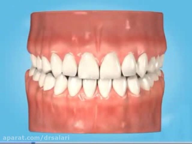 Occlusal ، سطح جونده دندان