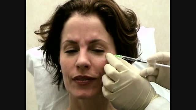 تزریق بوتاکس برای درمان چروک اطراف چشم(خطوط پنجه کلاغی)
