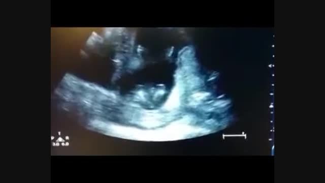 تصاویر سونوگرافی شادمانی جنین در شکم مادر...ببینید لطفا