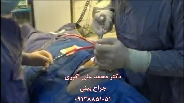 جراحی بینی-قسمت 3